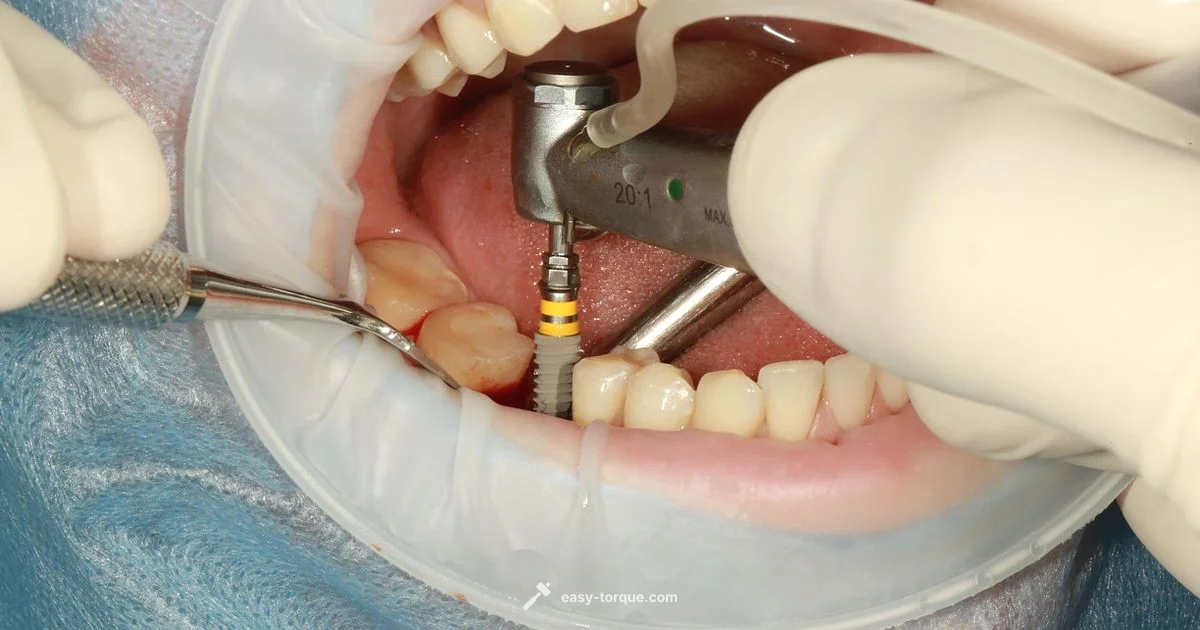 Torque Test in Implant - Easy Torque